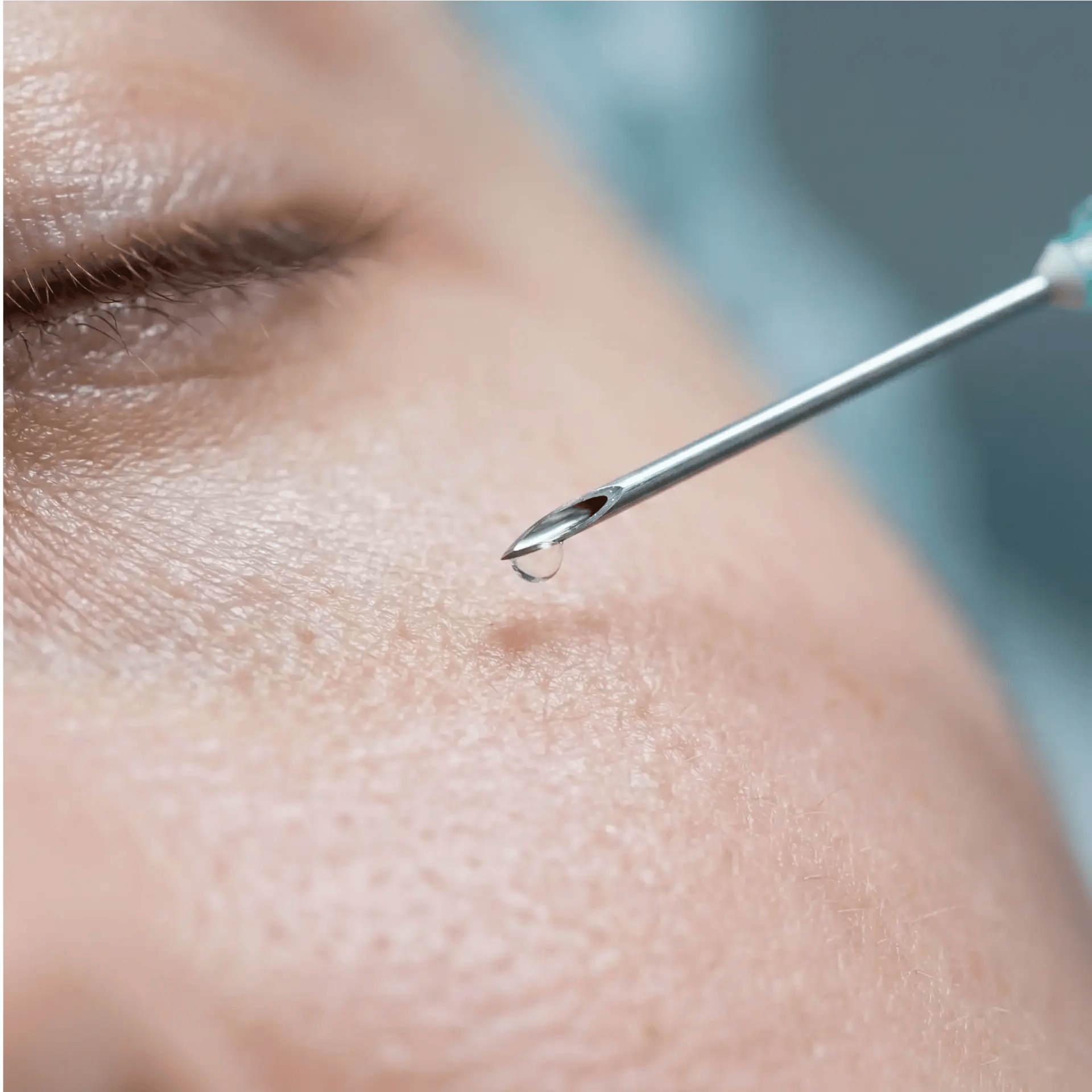 Botox injection