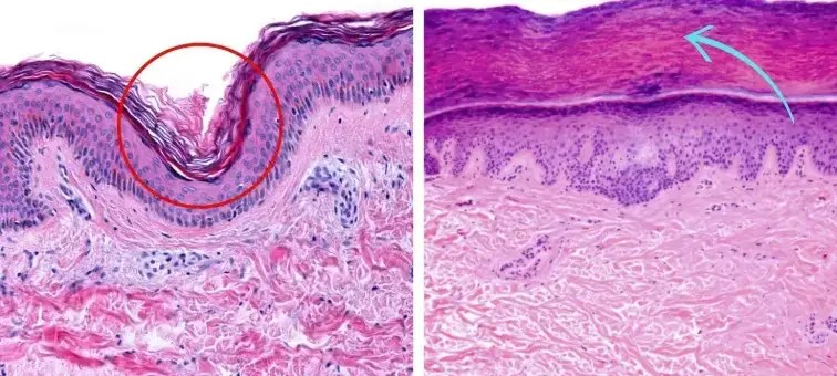 Under-eye skin layers showing root causes beneath the surface